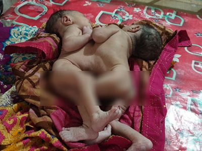 পেট জোড়া লাগানো দুই যমজ ছেলে শিশুর জন্ম