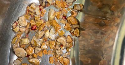 কিডনি থেকে চিকিৎসকরা  ২০৬টি পাথর বের করলেন