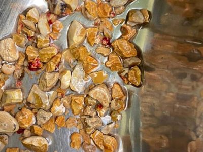 কিডনি থেকে চিকিৎসকরা  ২০৬টি পাথর বের করলেন