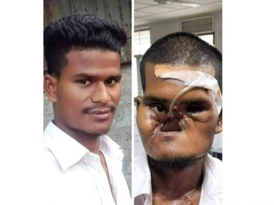 ছাত্র আন্দোলনে আহত খোকন বর্মনকে চেনা যায়না